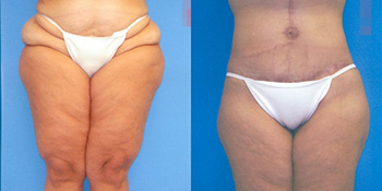 Lower Body Contouring