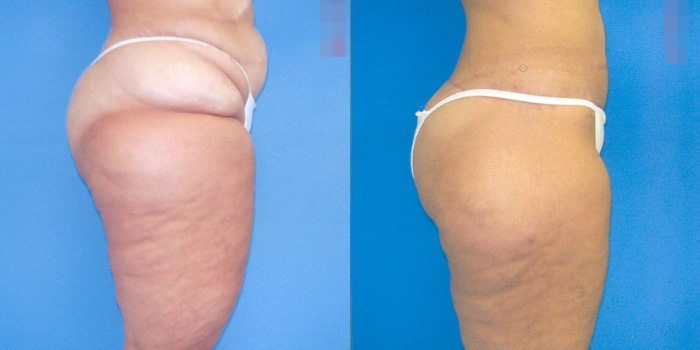 Lower Body Contouring
