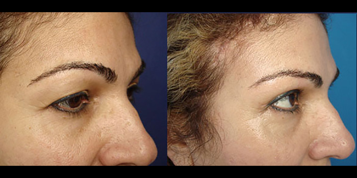 Brow Lift and Upper Eyelids