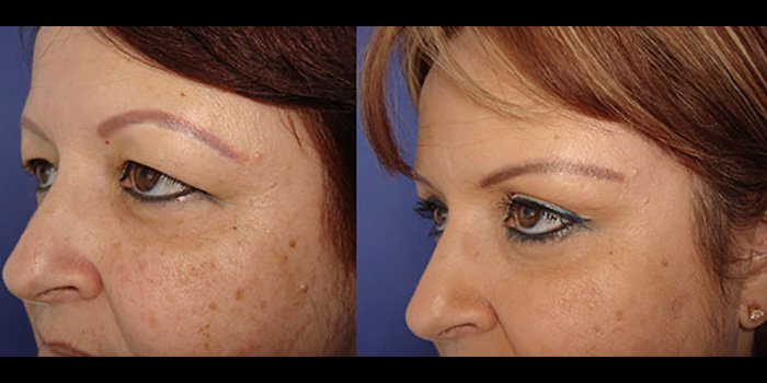 Brow Lift and Upper Eyelids